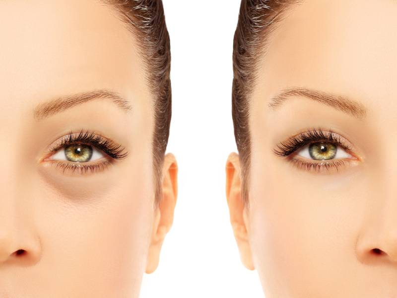 Blepharoplasty Unveiling The Windows To Your Soul Artemis Clinics Turkey S Premier Medical