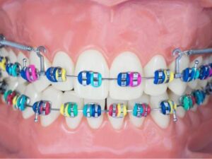 orthodontic braces