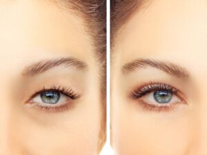 Blepharoplasty eyelid surgery