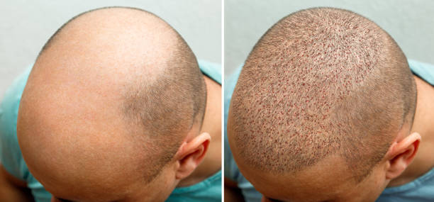 FUE hair transplantation