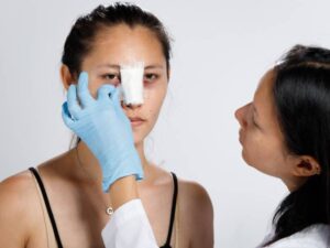 rhinoplasty nose job