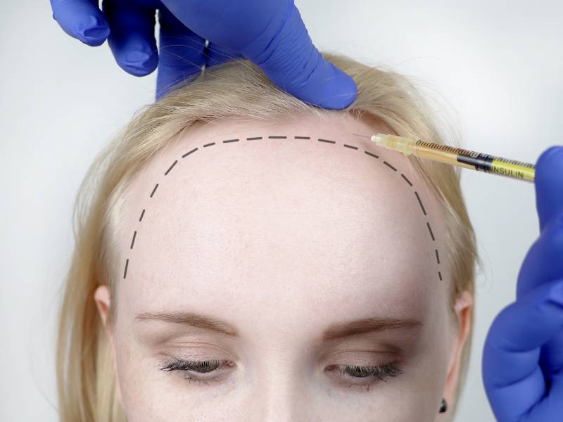 Hair transplant for women