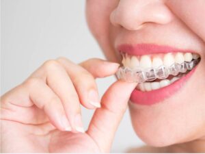 invisalign