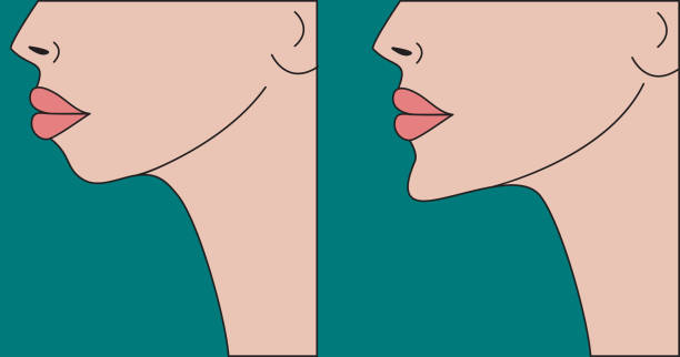 chin implant