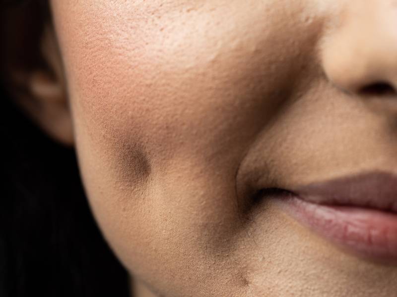 cheek dimples dimpleplasty