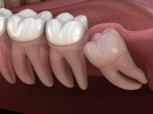 wisdom tooth impacted