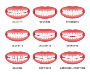 overbite, underbite, crossbite, crowding and spacing