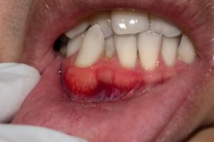 Periodontal problem, gum disease