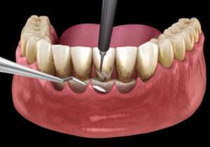 scaling and root planing, gum disease treatment