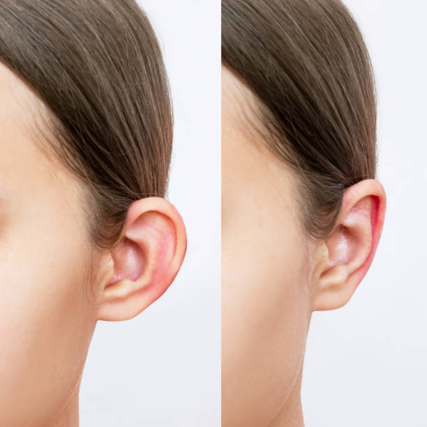 otoplasty before and after ear surgery